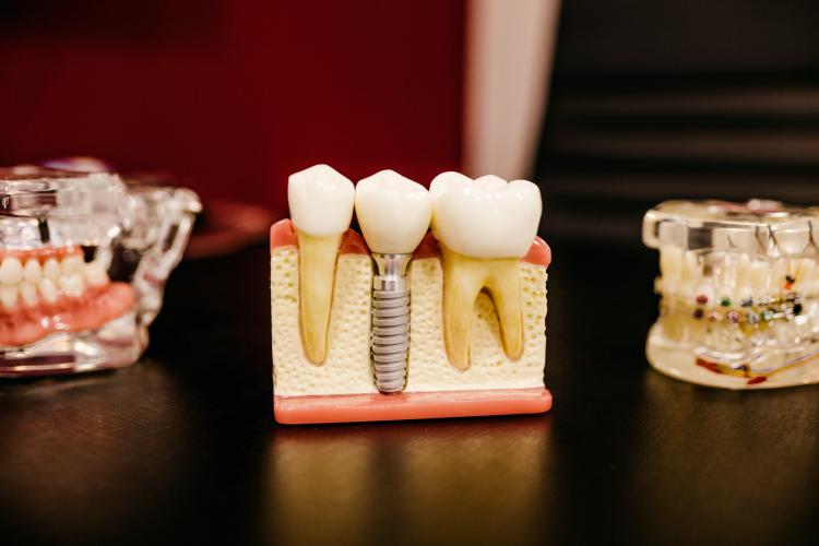 Ile kosztują implanty zębów? Implanty cena
